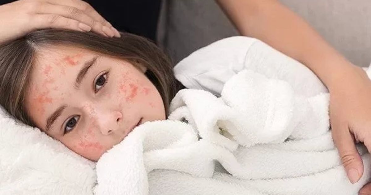 Waspada Campak: Penyakit Lama yang Kembali Mengancam di Era Modern