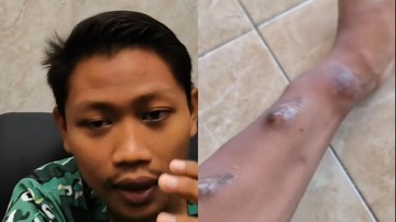 Pemuda ini mengidap gagal ginjal di usia 20-an tahun. (Foto: IG @edipaeji dengan izin yang bersangkutan)