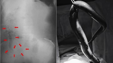 Foto: International Journey of Surgery Case Reports